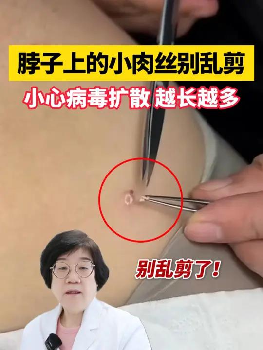 脖子长这种小肉条,说明你已经感染HPV病毒了