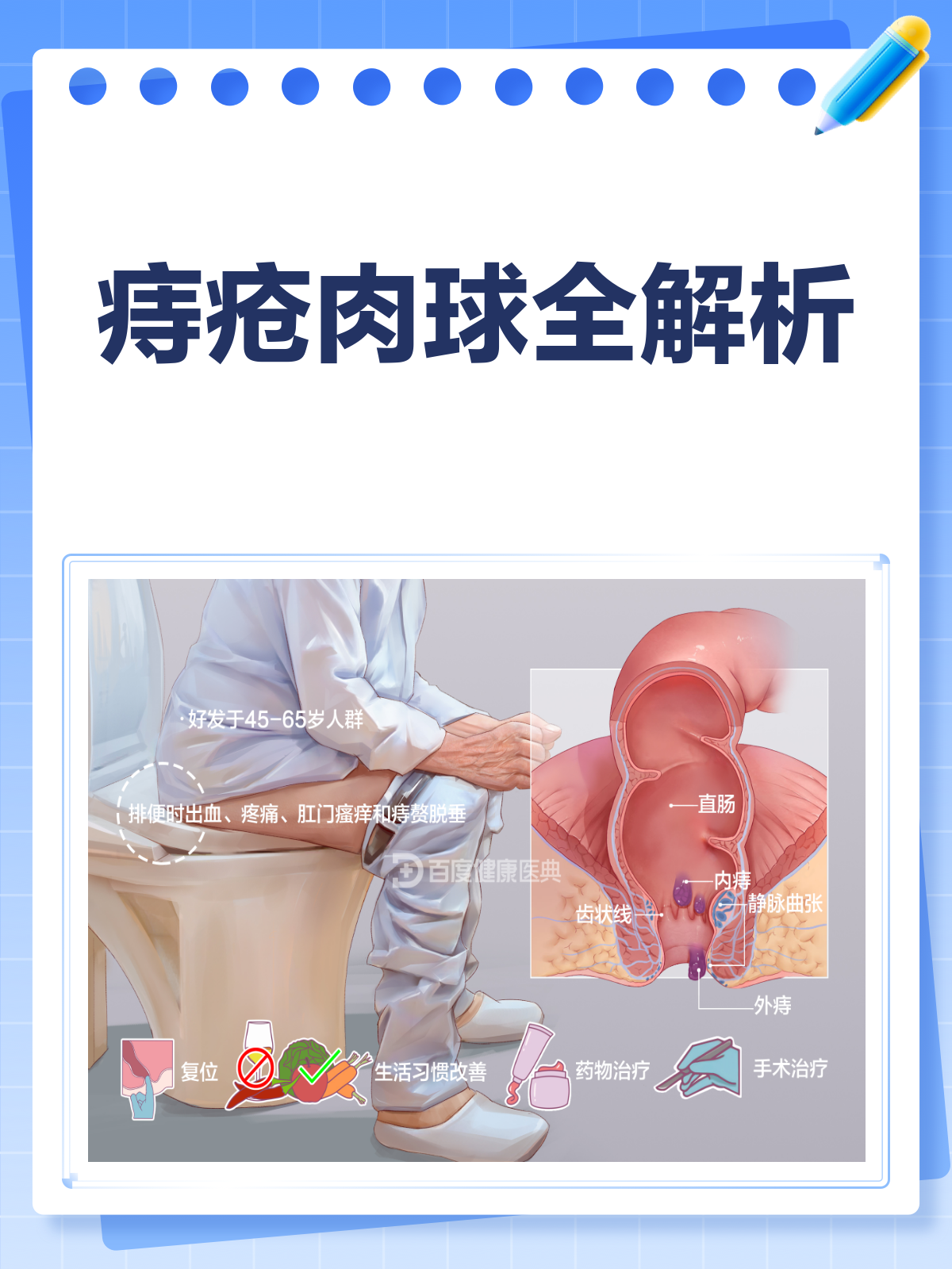 痔疮肉球别再拖!认清症状早处理