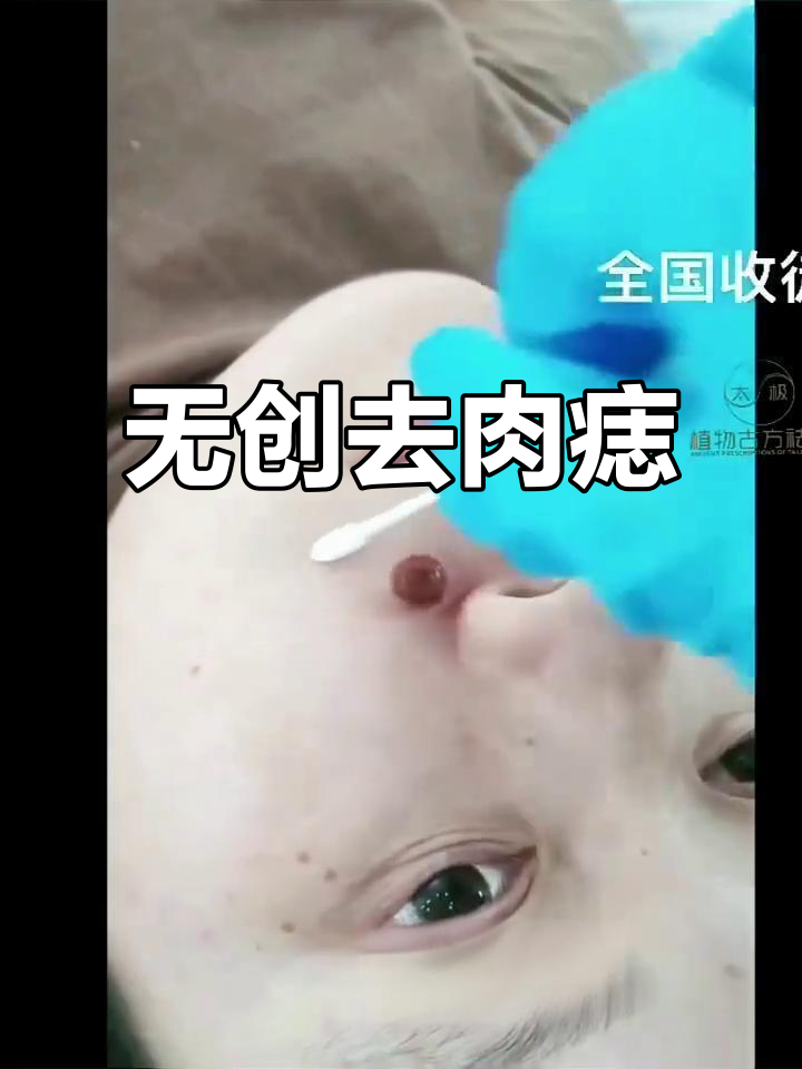 鼻子旁大肉痣轻松去除，7-15天自然脱痂