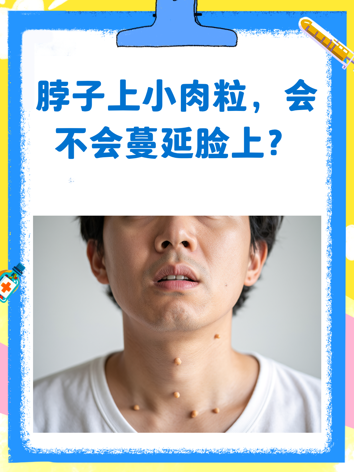脖子上的小肉粒,会“爬”到脸上吗?
