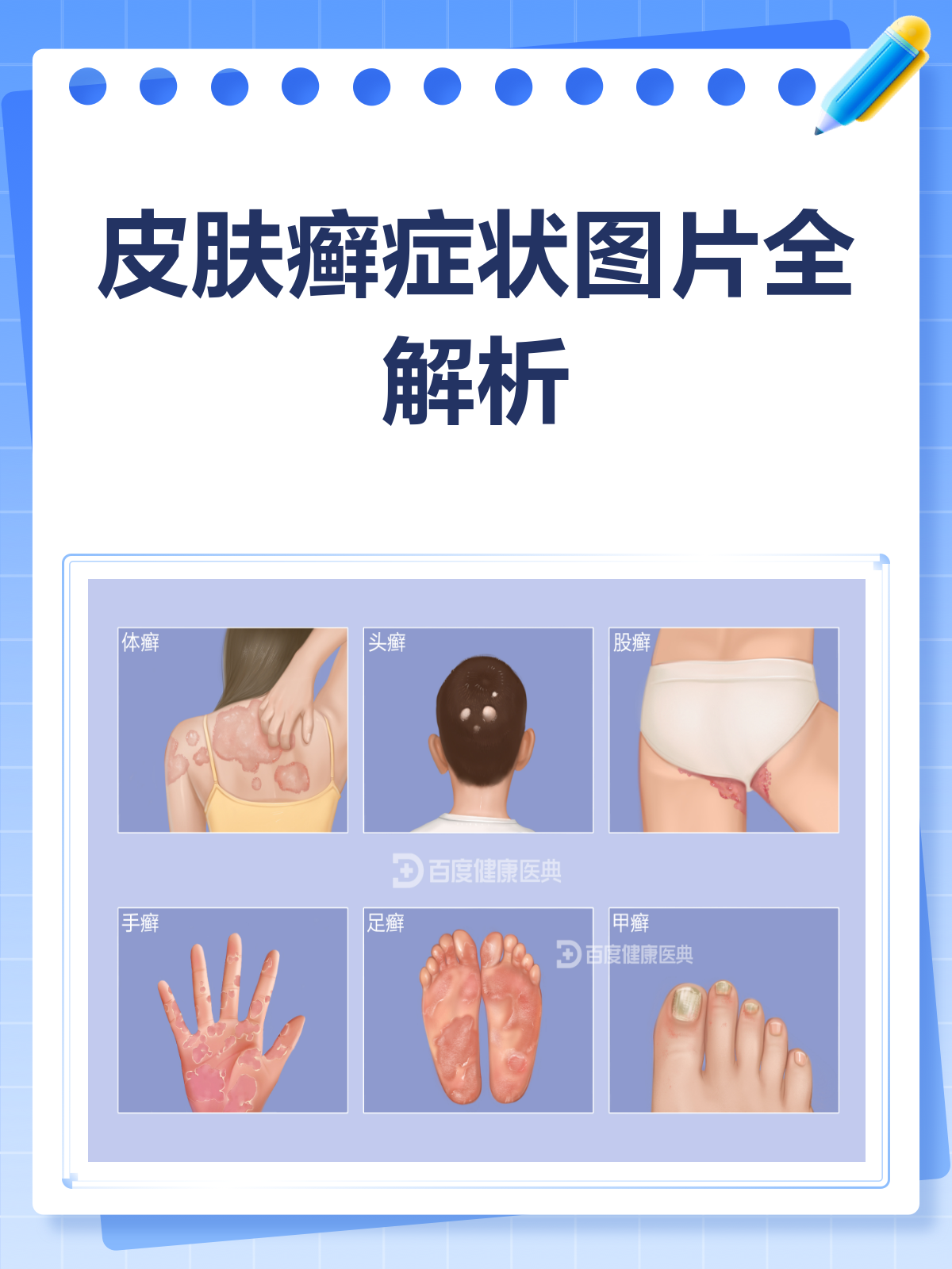 皮肤癣来袭?症状图片帮你一眼识别!