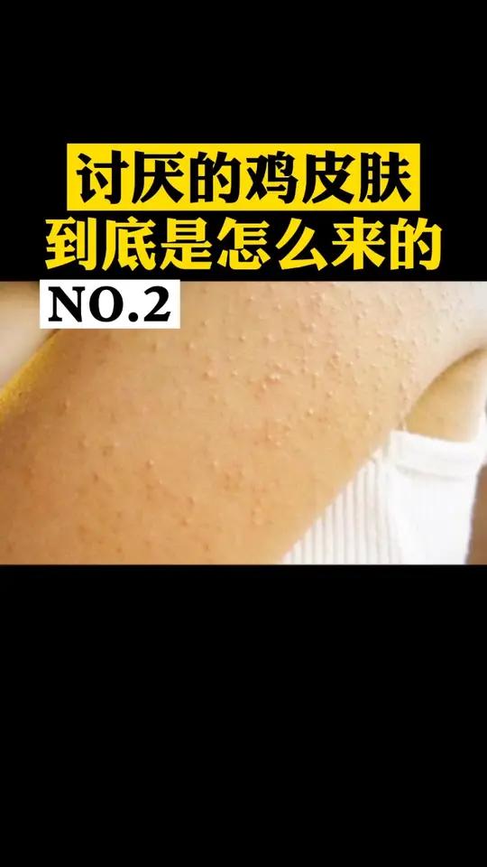 长了鸡皮肤,不敢穿背心?这烦人的“鸡皮”究竟是怎么来的