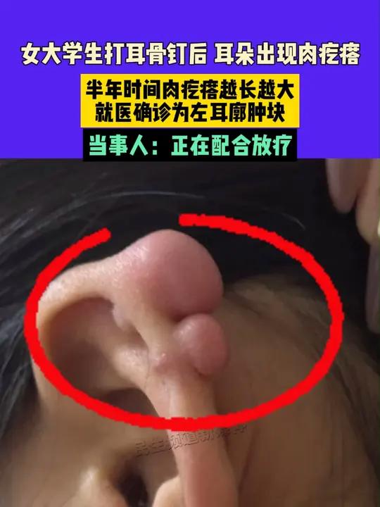 9月4日(发布)河南,女大学生打耳骨钉后,耳朵出现肉疙瘩,半年时间肉疙瘩越长越大,就医确诊