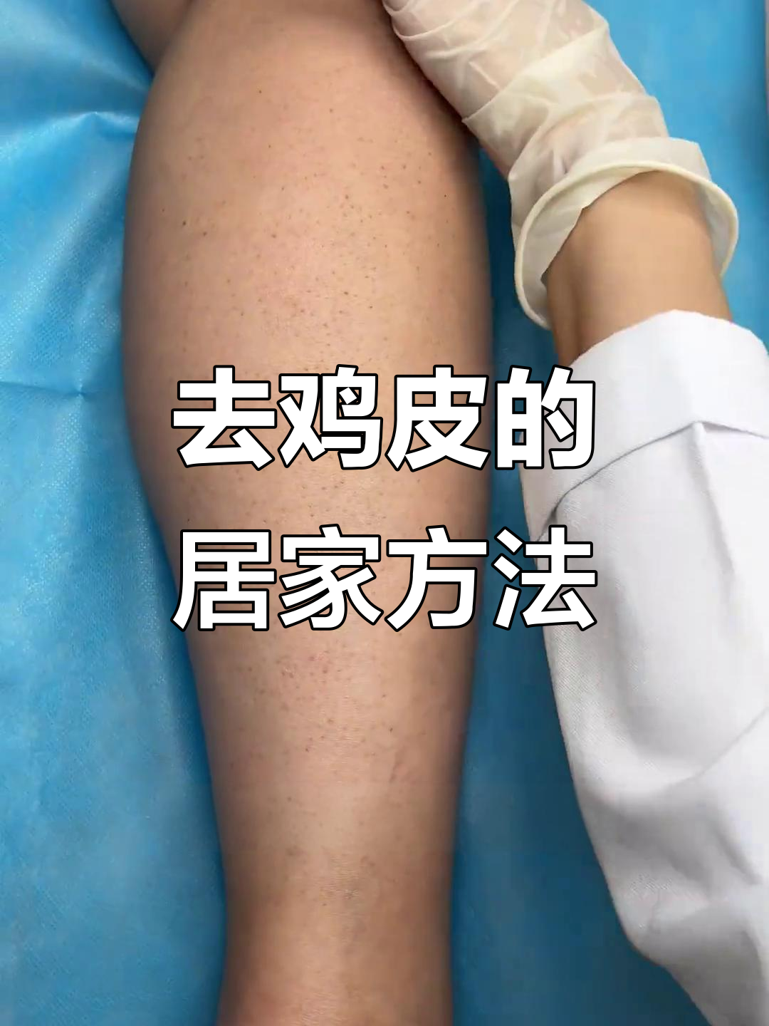 夏季来临,手臂小腿有鸡皮?教你家居护理小技巧