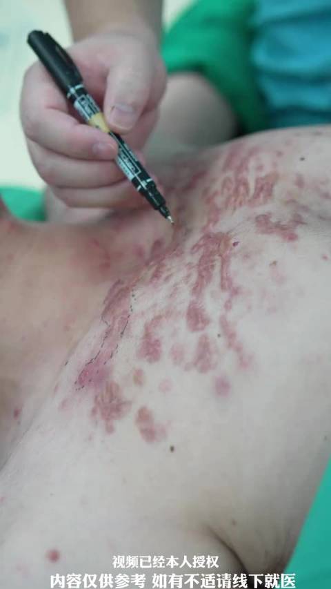前胸部大面积疤痕疙瘩切除术  前胸条索状的片状疤痕疙瘩,像树一样分布……这就需要多维度的去