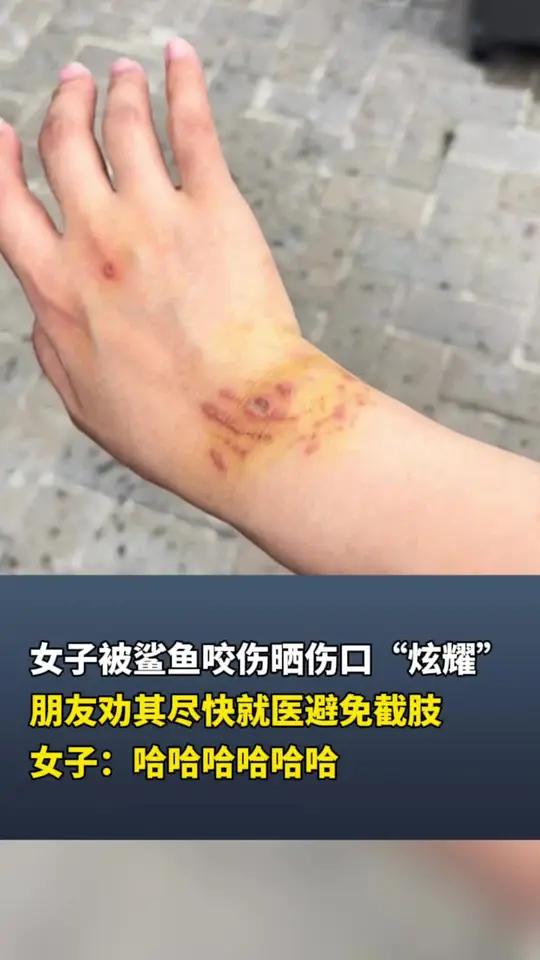 女子被鲨鱼咬伤晒伤口“炫耀” 朋友劝其尽快就医避免截肢 女子:哈哈哈哈哈哈