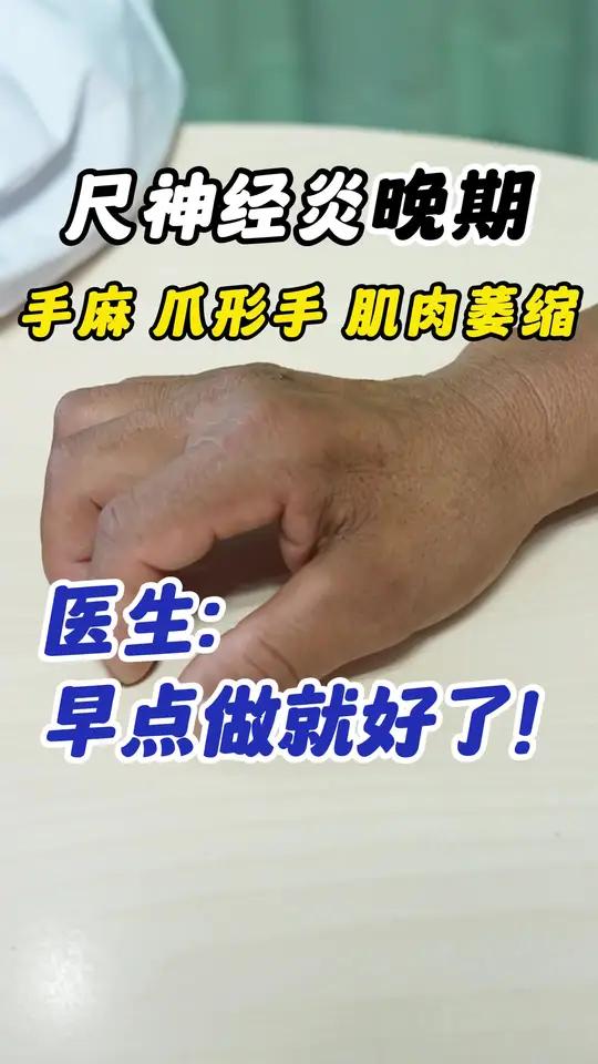 患者尺神经受损严重,手麻、手无力、出现“爪形手”、肌肉严重萎缩,影响日常生活
