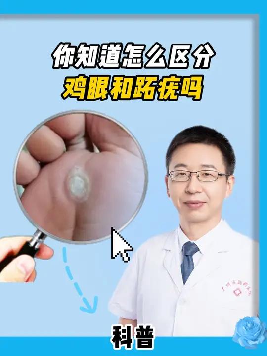 脚底的硬疙瘩是鸡眼还是HPV感染的跖疣
