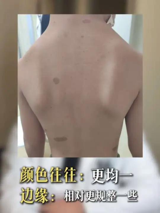 咖啡牛奶斑和色素痣区别 #儿外科医生徐升 #徐升 #牛奶咖啡斑 #神经纤维瘤病 #神经纤维