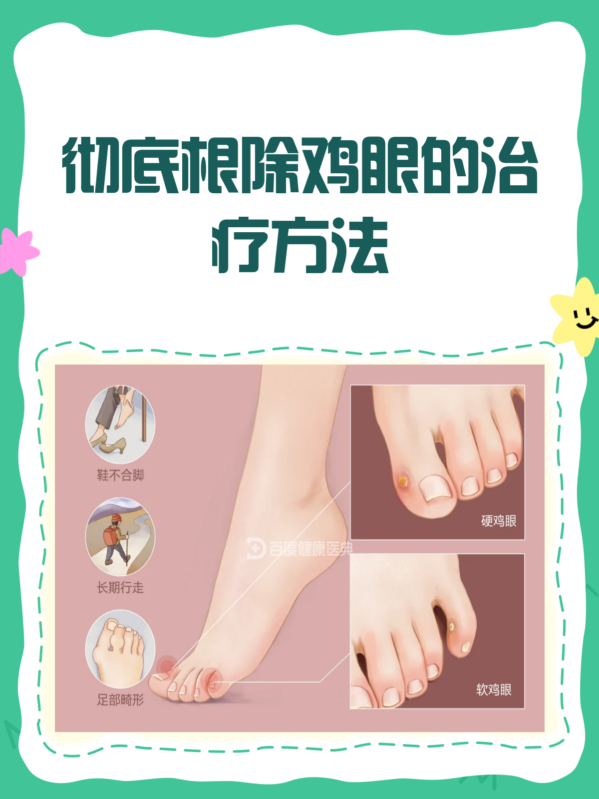 鸡眼烦恼别再有！彻底根除就看这一篇