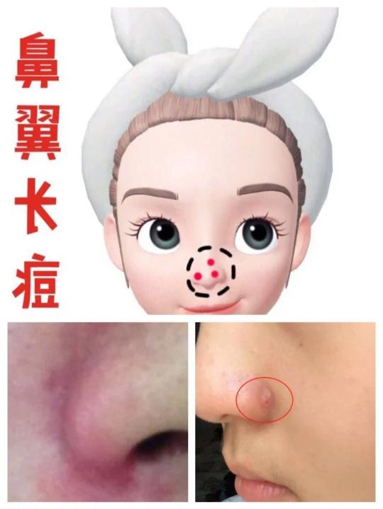 鼻翼长痘,我用中医理论自救|2天解除烦恼