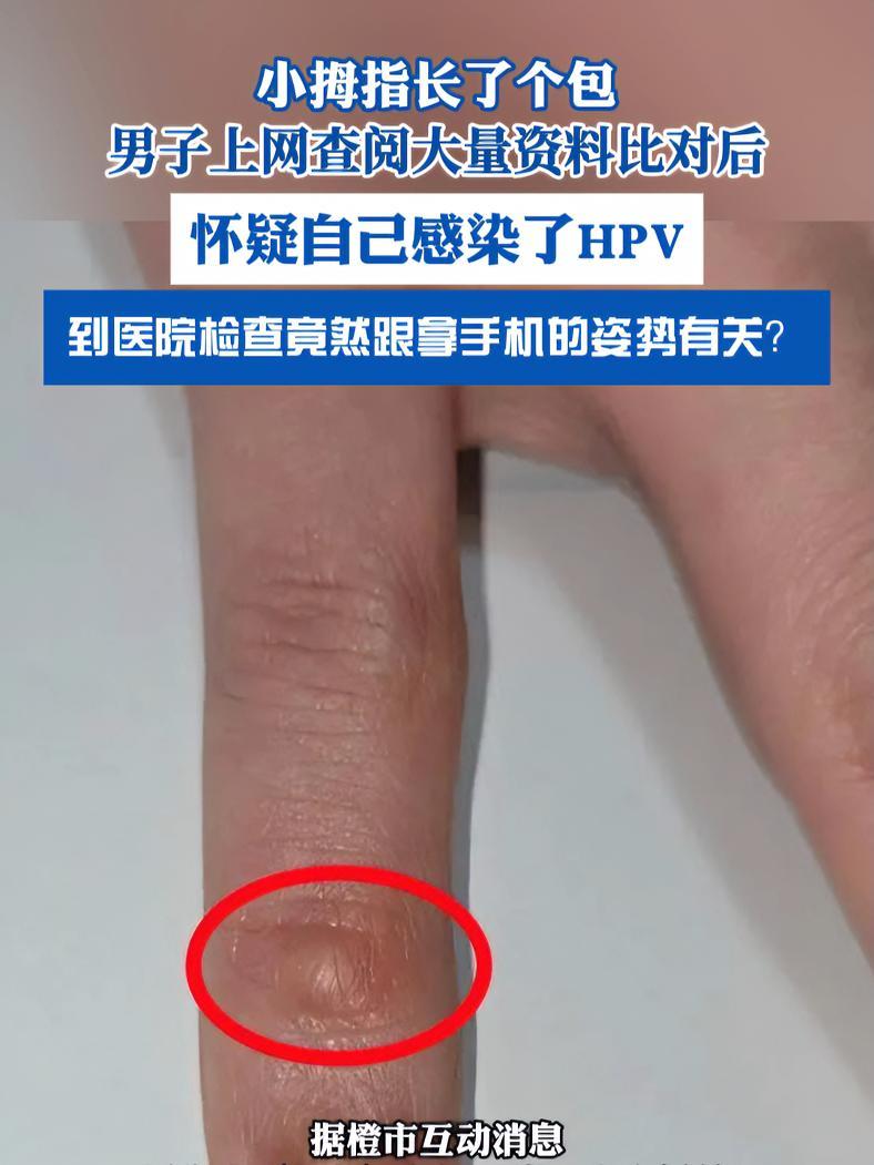 小拇指长了个包,男子怀疑自己感染了HPV