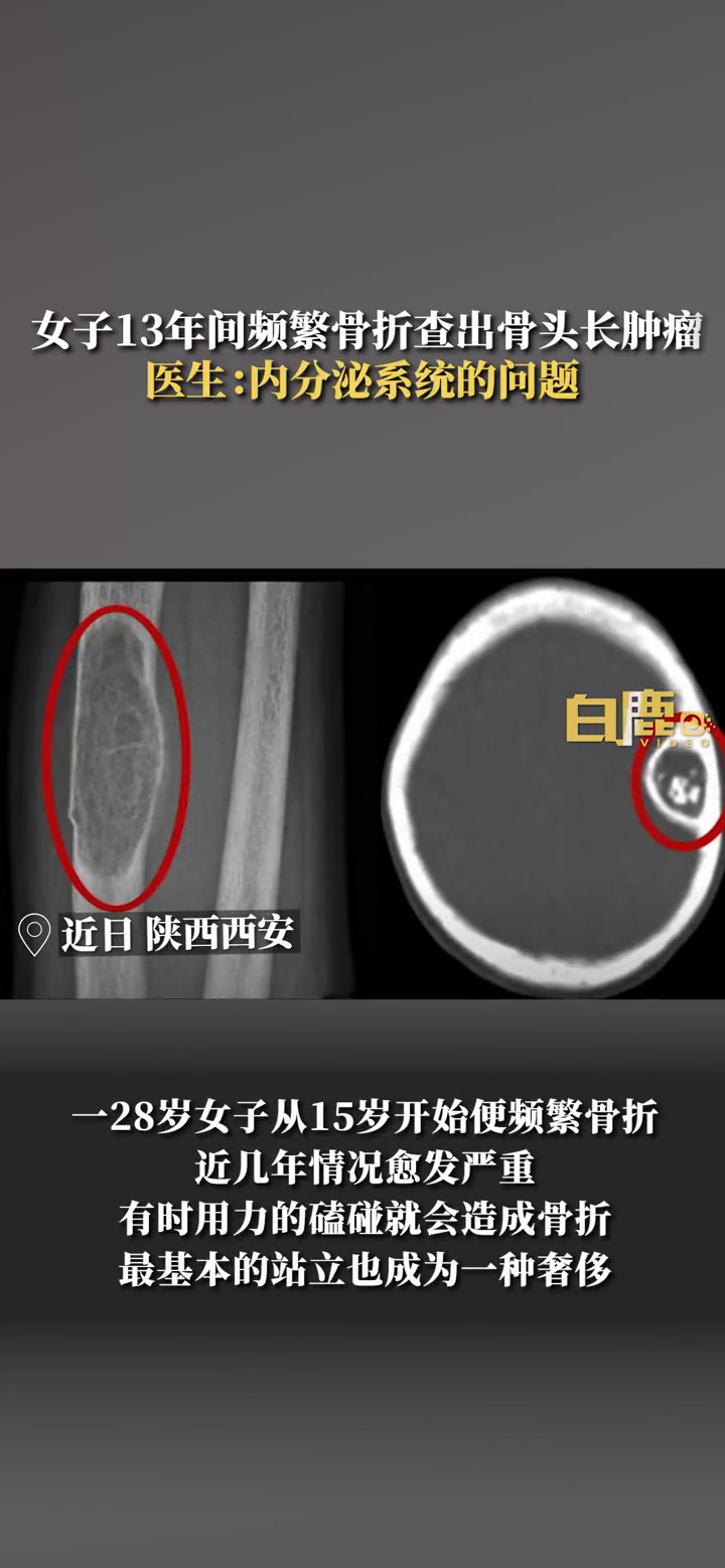 女子13年间频繁骨折查出骨头长肿瘤 医生:是内分泌系统问题