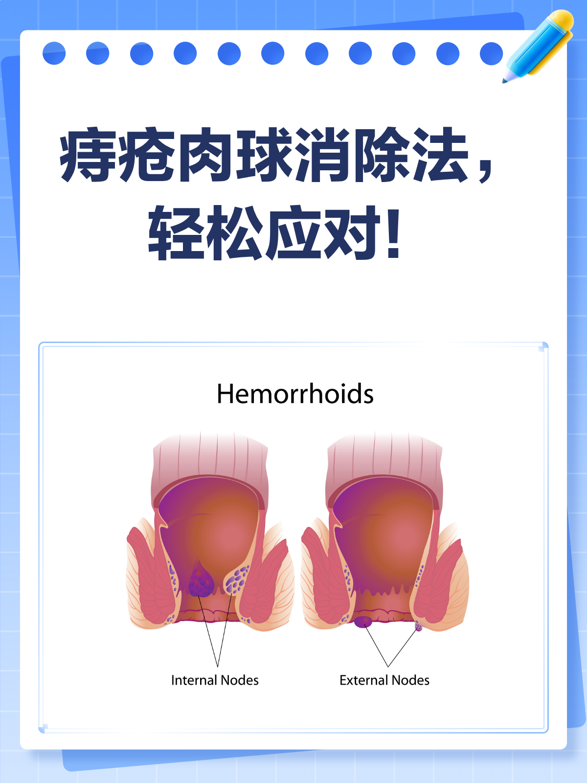 痔疮肉球太烦人？这些方法帮你轻松消除！