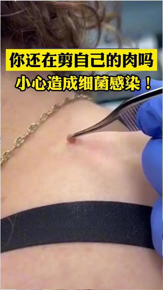 这种小肉粒你会去剪它吗