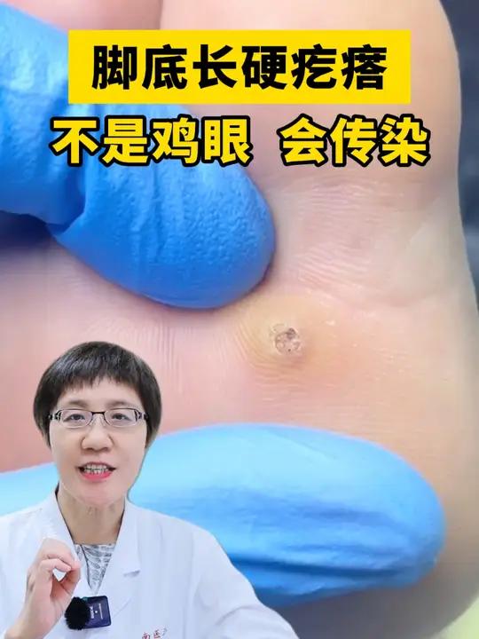 脚底长粗糙的硬疙瘩,这可不是鸡眼,是hpv病毒感染引起的跖疣