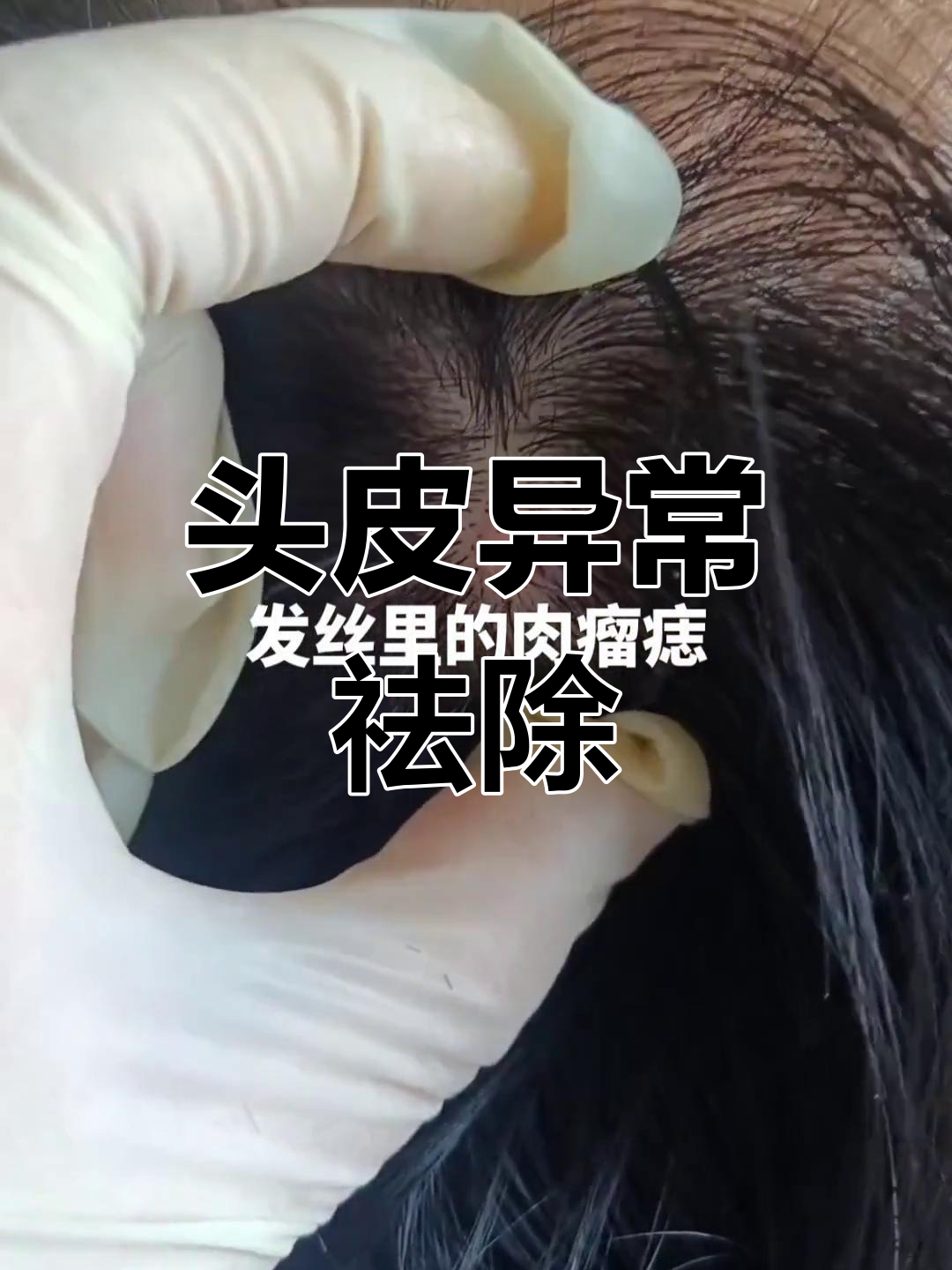 头发内肉瘤痣需及时清除,避免潜在健康风险