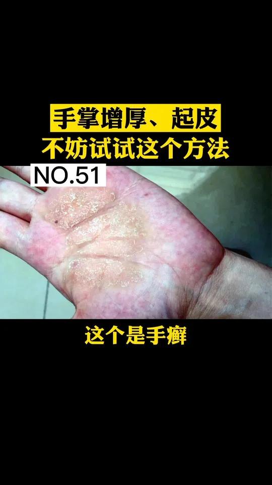 手上脱皮,变厚,手癣该如何治疗呢