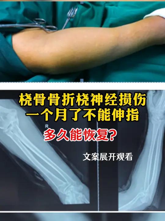 桡骨骨折桡神经损伤一个月了不能伸指,多久能恢复?恢复的时间需要根据桡神经损伤的严重程度以及
