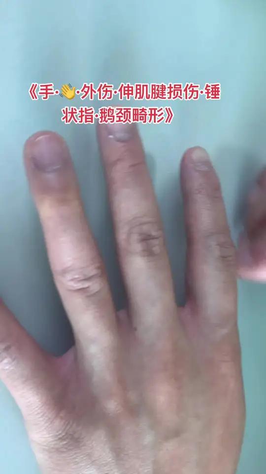 粉丝看到我们的视频 打篮球出现手指锤状指 鹅颈畸形?手 手指外伤手外伤锤状指伸肌腱损伤伸肌