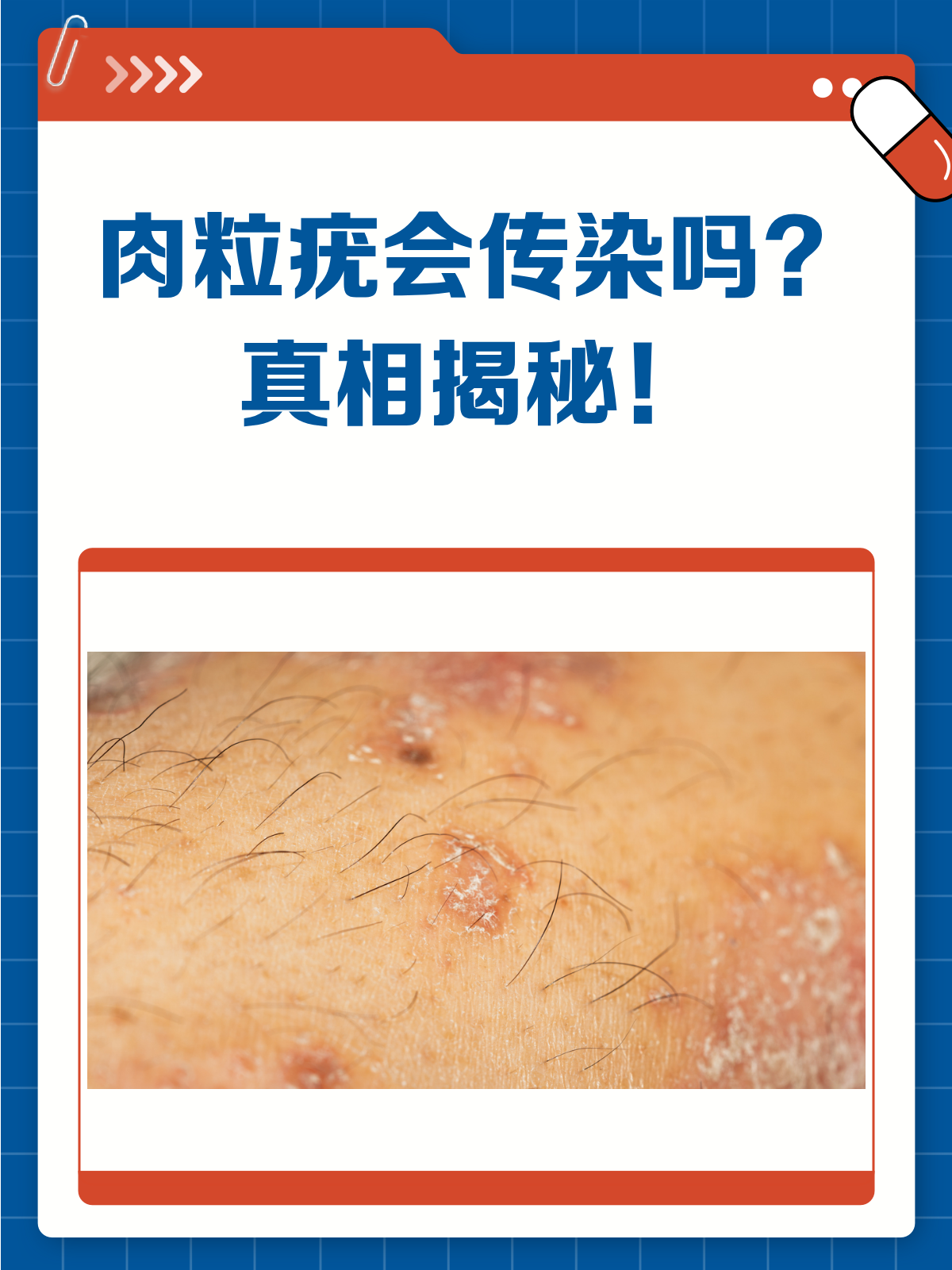 肉粒疣会传染吗?答案在这里!