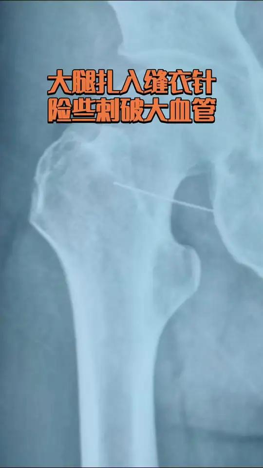 缝衣针扎入大腿,会随着肌肉运动穿刺游走,一定要小心,及时就医