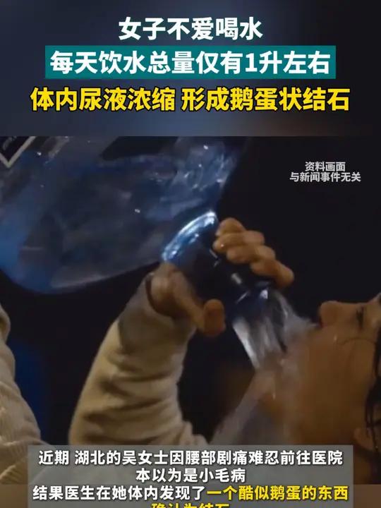 女子不爱喝水 每天饮水总量仅有1升左右 体内尿液浓缩 形成鹅蛋状结石喝水结石(编辑:嘻嘻)