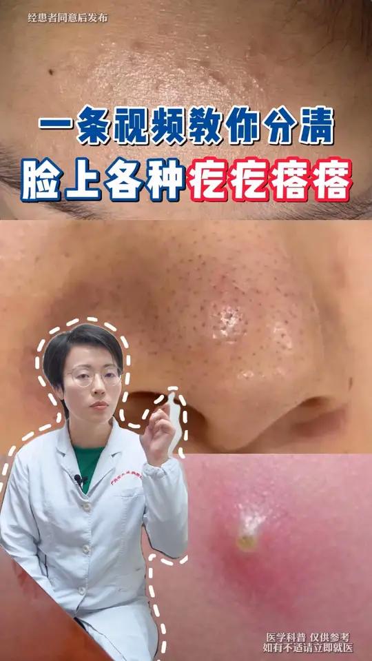 脸上的疙疙瘩瘩到底是什么怎么办?一条视频告诉你!