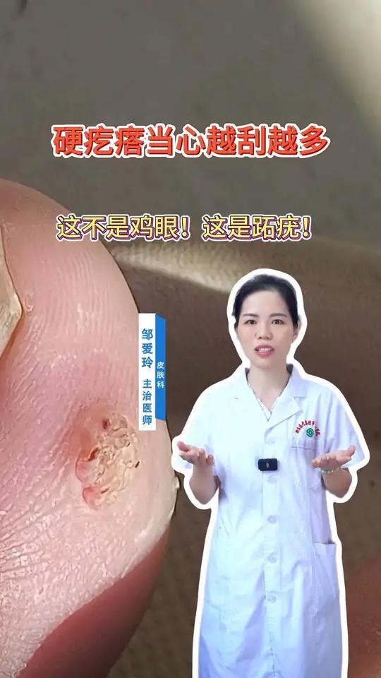 硬疙瘩当心越刮越多 这不是鸡眼这是跖疣