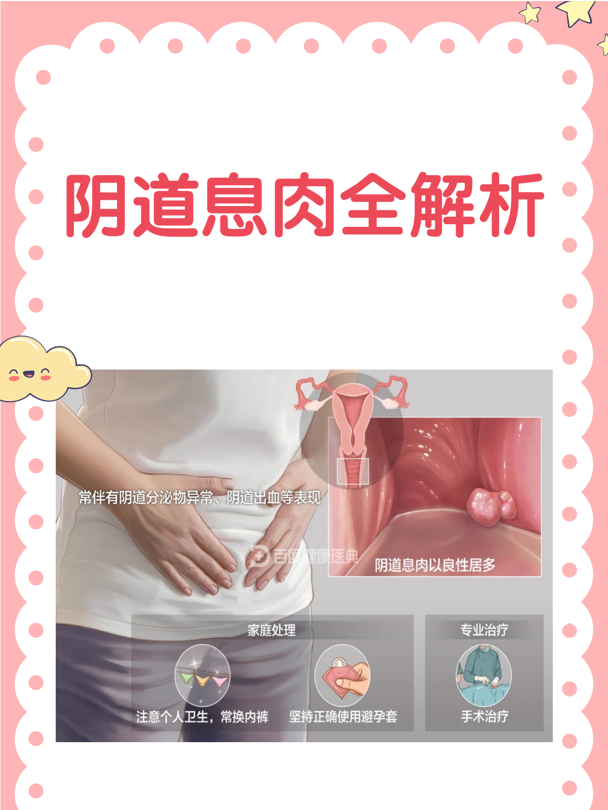 阴道息肉知多少？一文带你全面了解