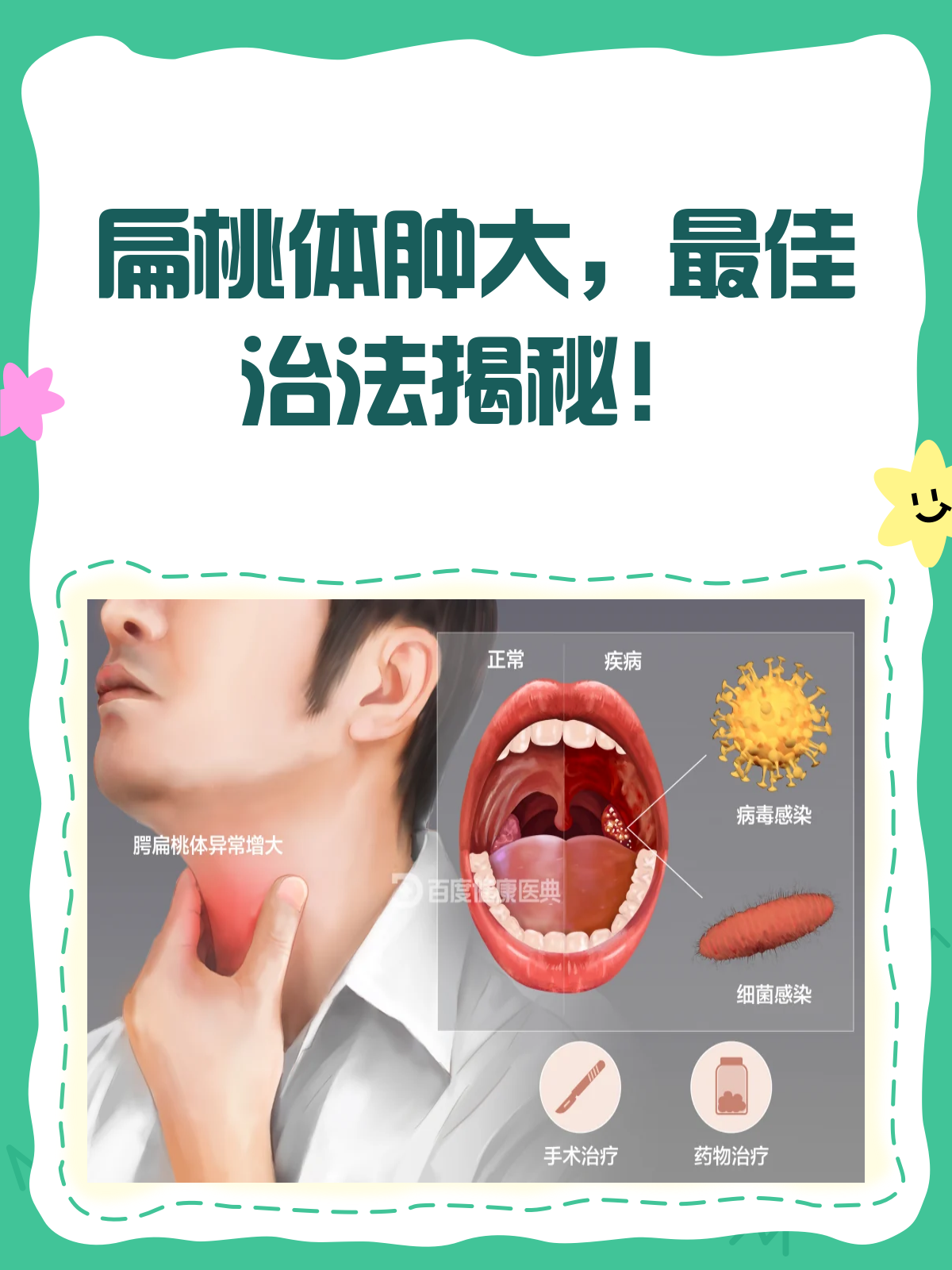 扁桃体肿大,怎么治才最好?