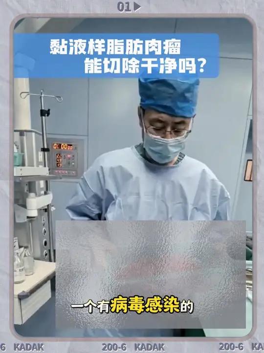 黏液样脂肪肉瘤能切除干净吗?