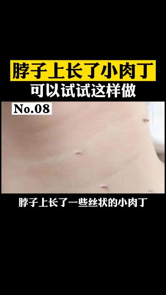 脖子上长的丝状小肉丁,可能是丝状疣是由HPV病毒引起的,具有传染性,你可以这样做
