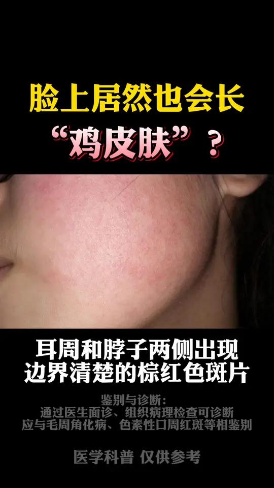 脸上小颗粒泛红就是鸡皮肤?科普毛周角化