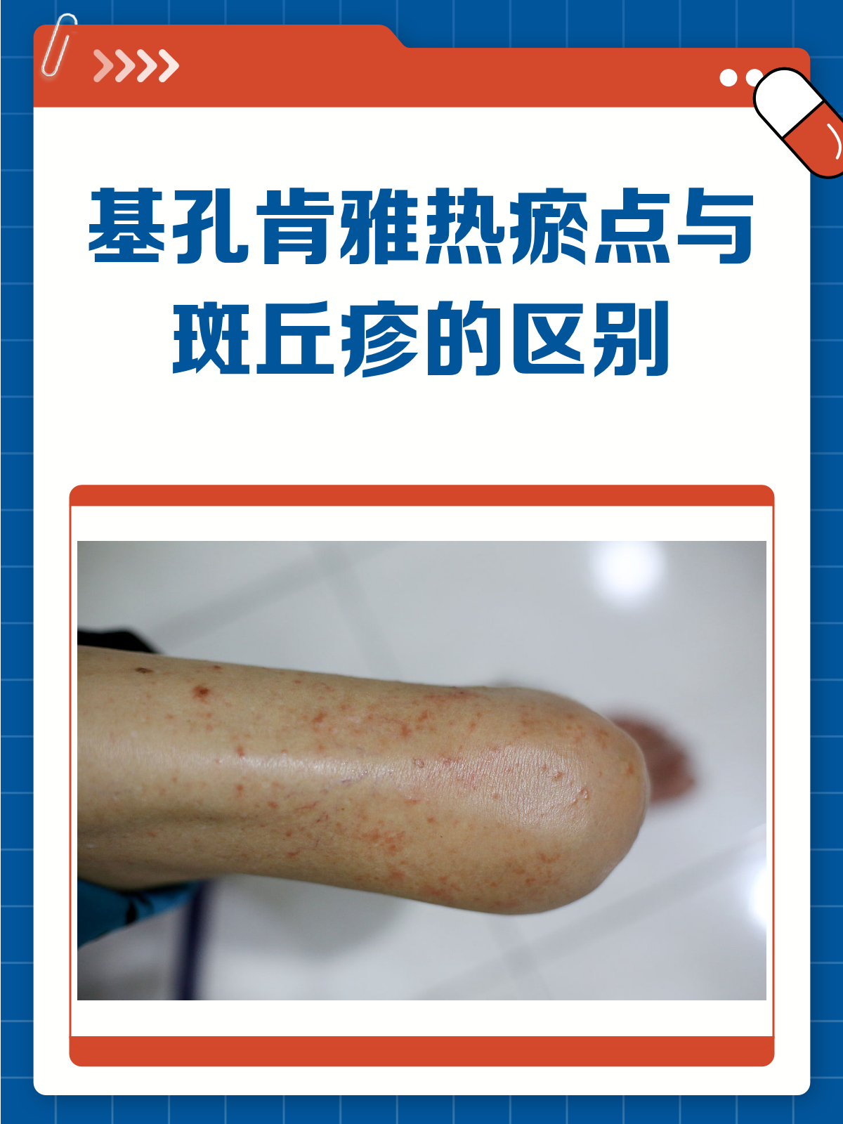 基孔肯雅热vs斑丘疹,皮肤表现大不同!