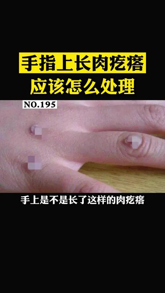 手上长了浅褐色或者肤色的粗糙肉疙瘩,这是寻常疣,别去剪它,容易越长越多!可以这样处理