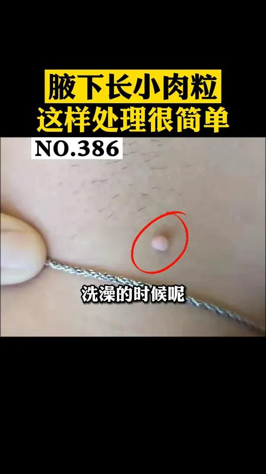 腋下长了小揪揪,摸上去软软的,可以这样处理