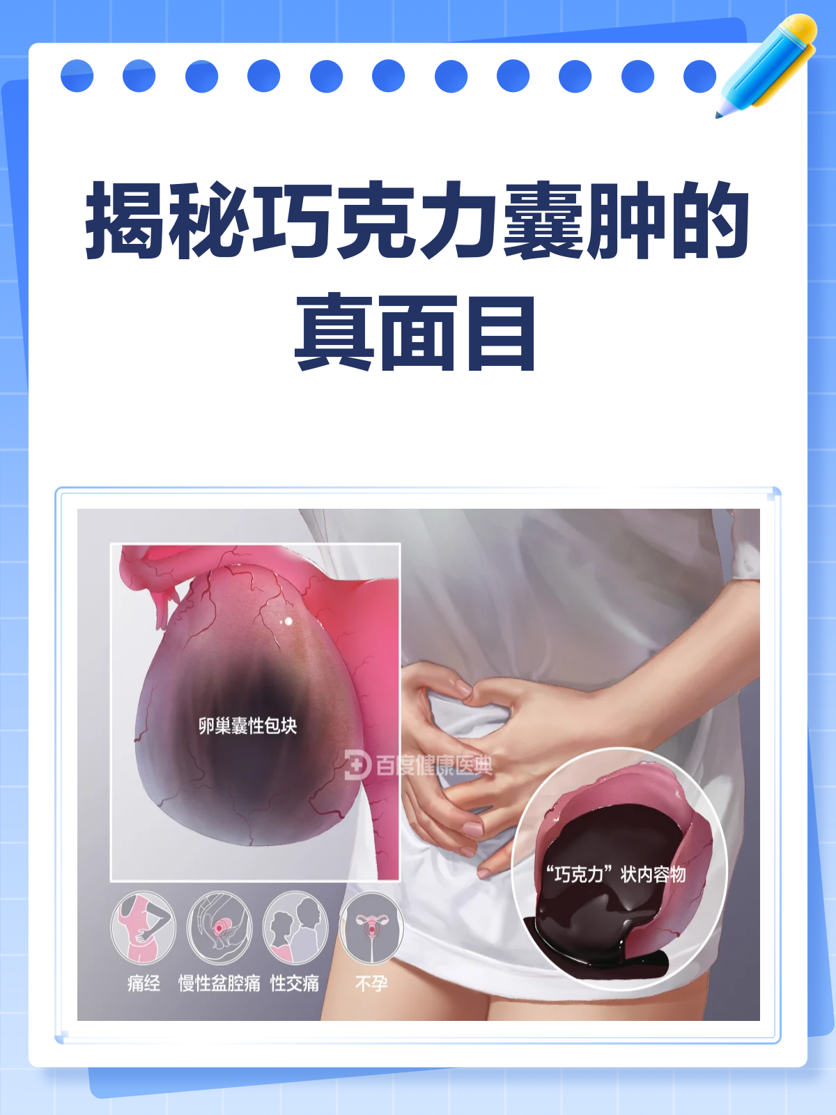 揭秘巧克力囊肿,它真不是甜蜜的烦恼!