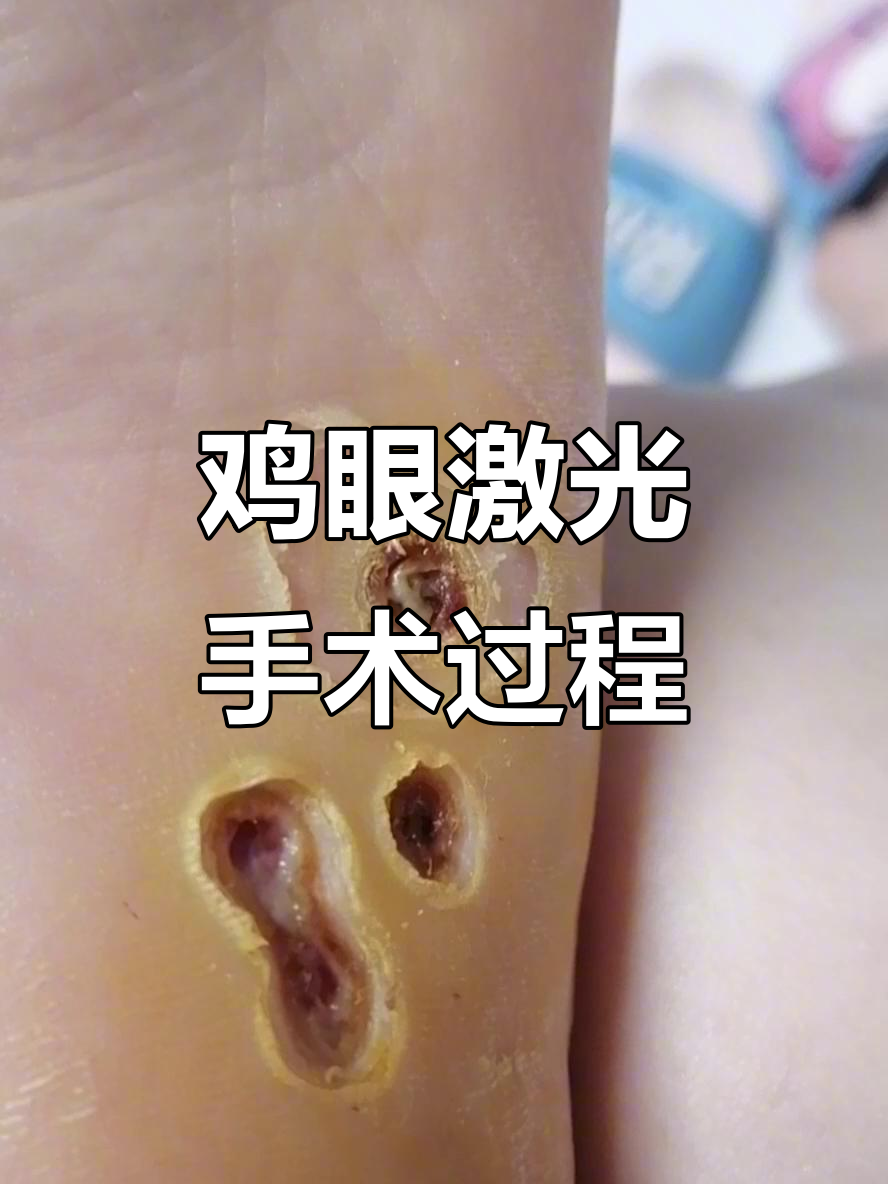 激光治疗鸡眼全过程,轻松去除痛苦不再有