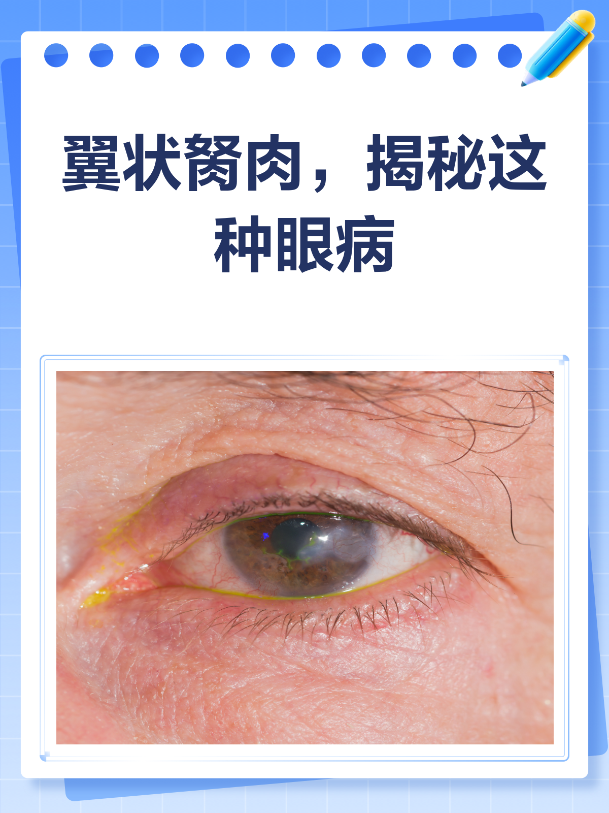 翼状胬肉?这种眼病你需要了解!