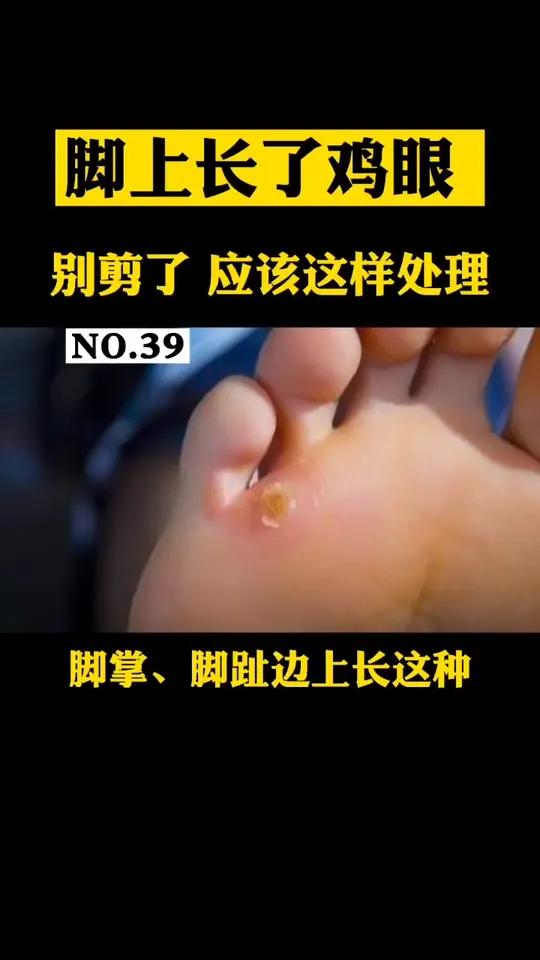 脚底长了鸡眼一走路就疼,担心路边修脚不安全也不卫生,可以试试这样做