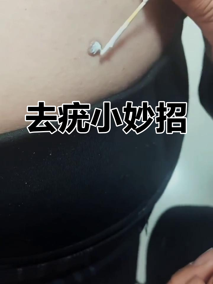 腋下肉粒轻松去除,15天见效!