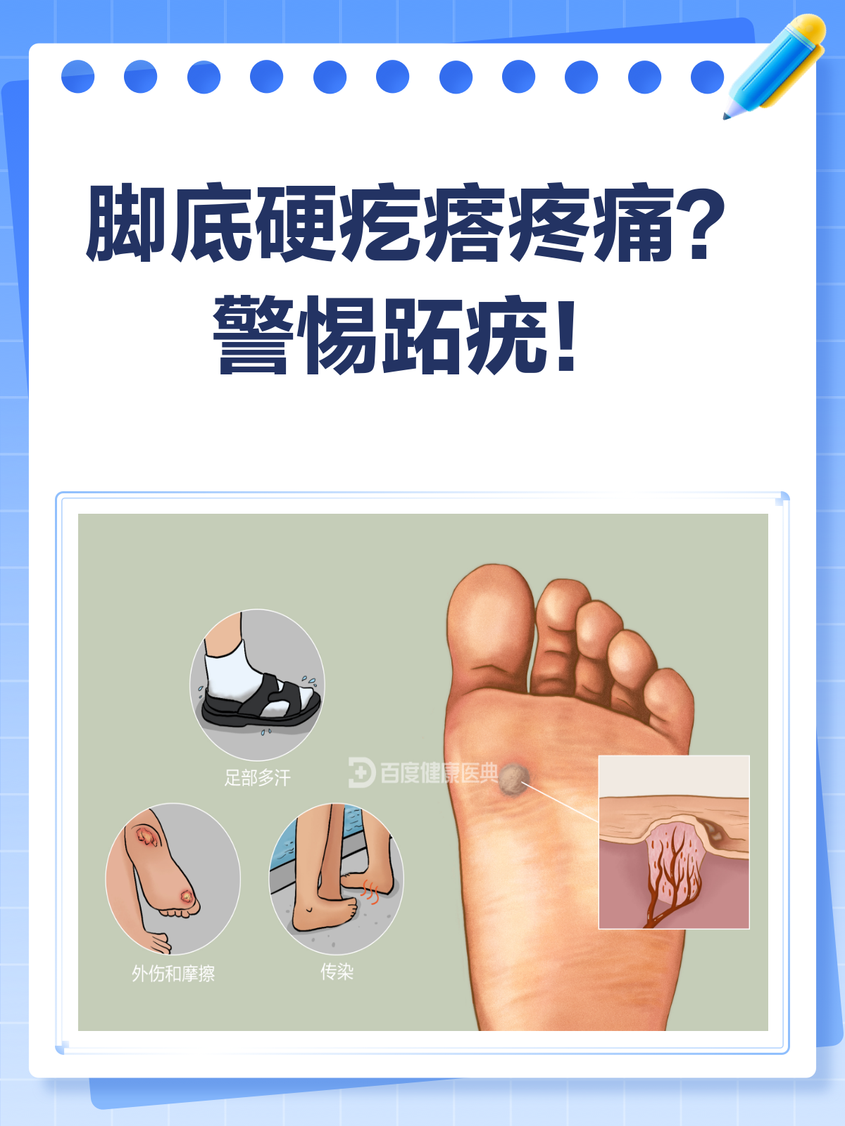 脚底长硬疙瘩?可能是跖疣在作怪!