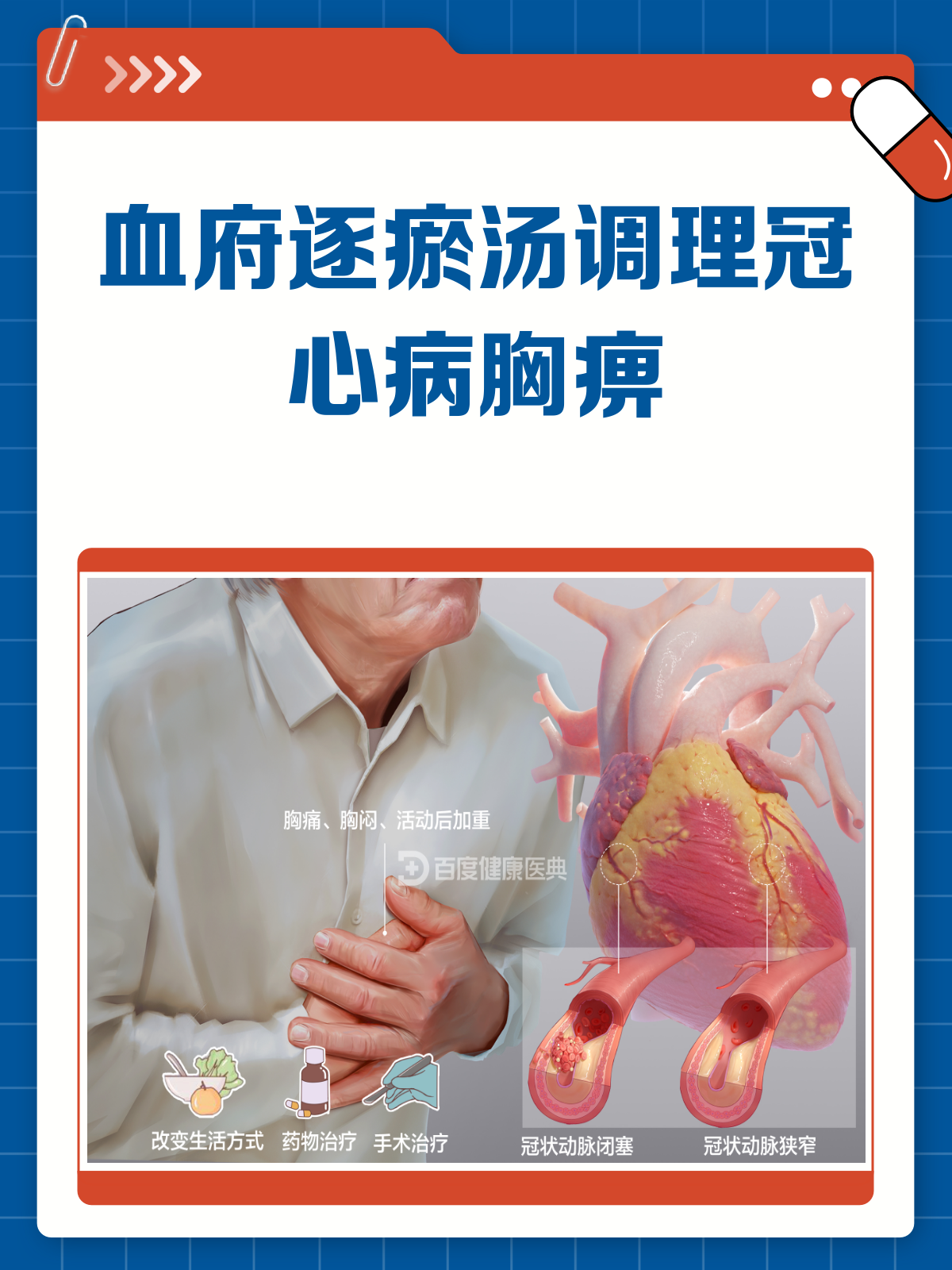血府逐瘀汤,冠心病胸痹的调理良方