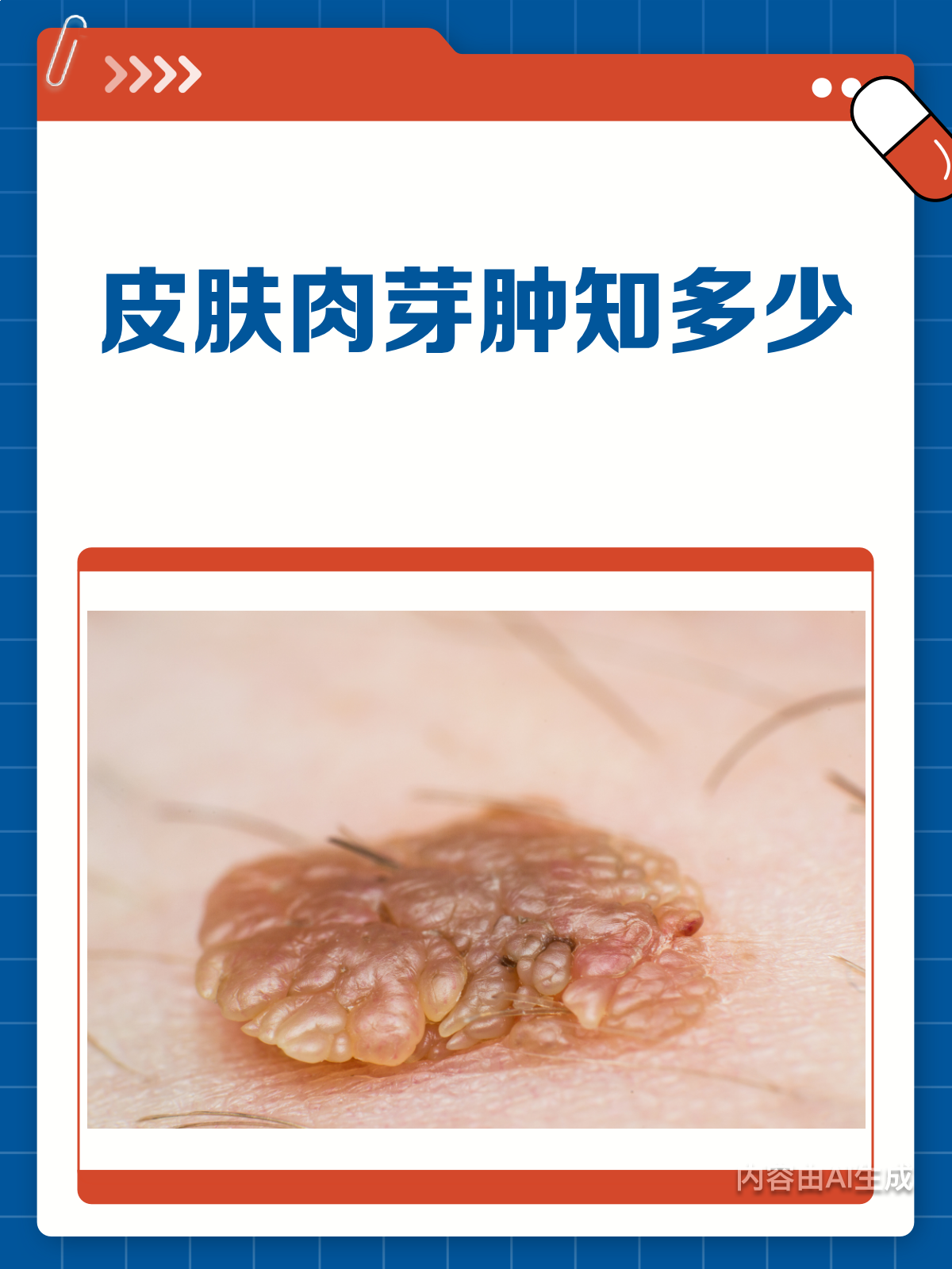 皮肤上的小红肉疙瘩?警惕化脓性肉芽肿!