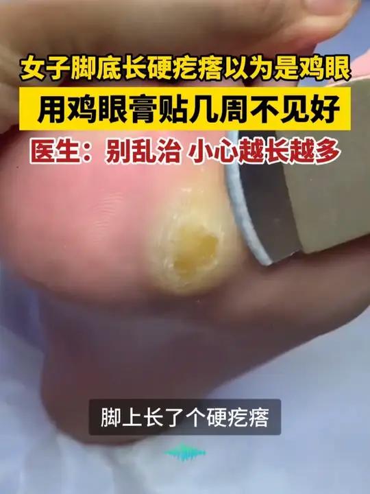 脚底长硬疙瘩，别再乱处理了，医生教你正确处理#跖疣 #HPV #医学科普 #鸡眼 #传染