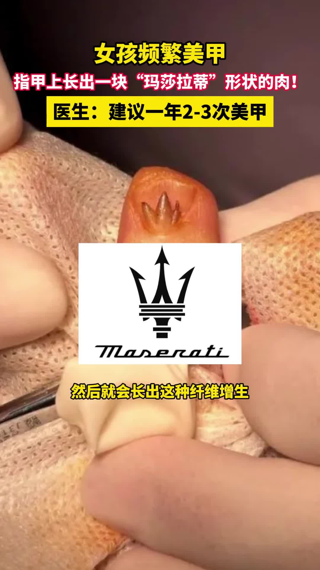 女孩频繁美甲,指甲上长出一块“玛莎拉蒂”形状的肉!医生:建议一年2-3次美甲