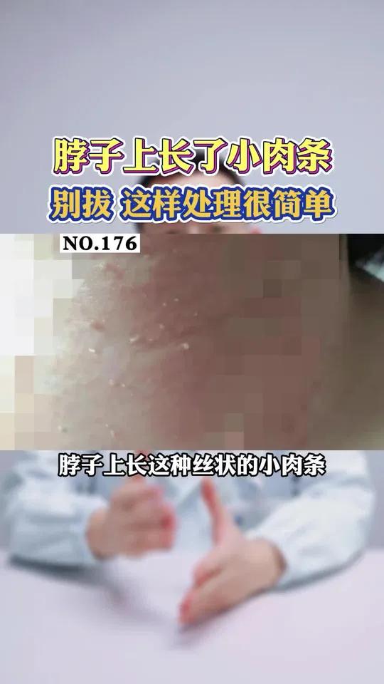 脖子上长小肉丝,不疼不痒,这可能是丝状疣!跟HPV有关!