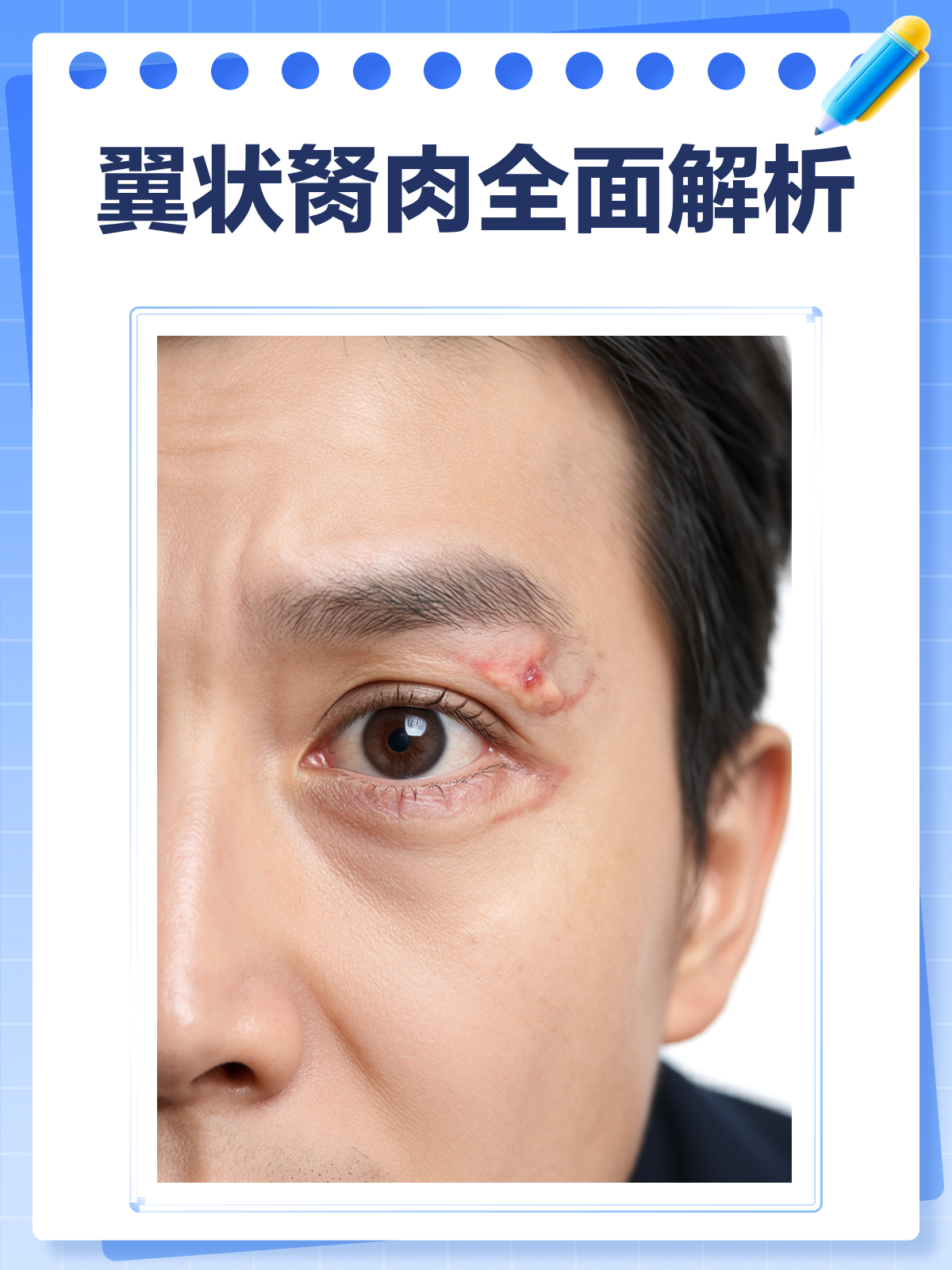 翼状胬肉：揭秘这种眼表疾病！