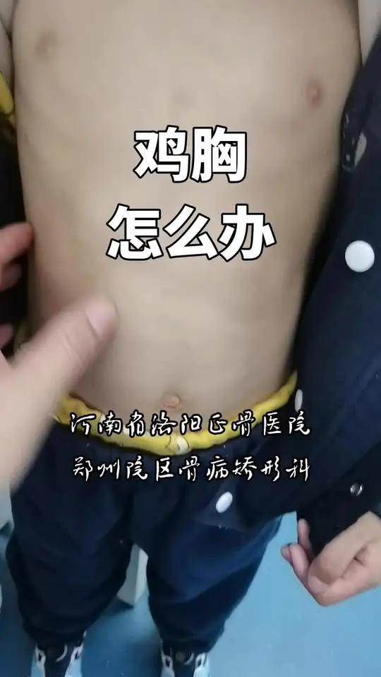鸡胸佝偻病怎么办鸡胸 宝宝鸡胸能恢复吗